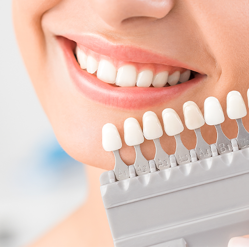 TEETH WHITENING / BLEACHING